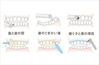 歯のクリーニング