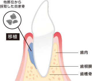 骨移植