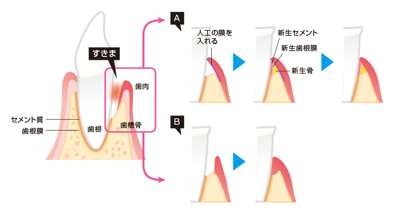 GTR法